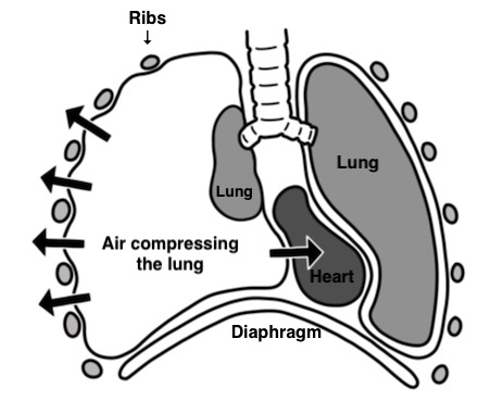 Tension Pneumothorax